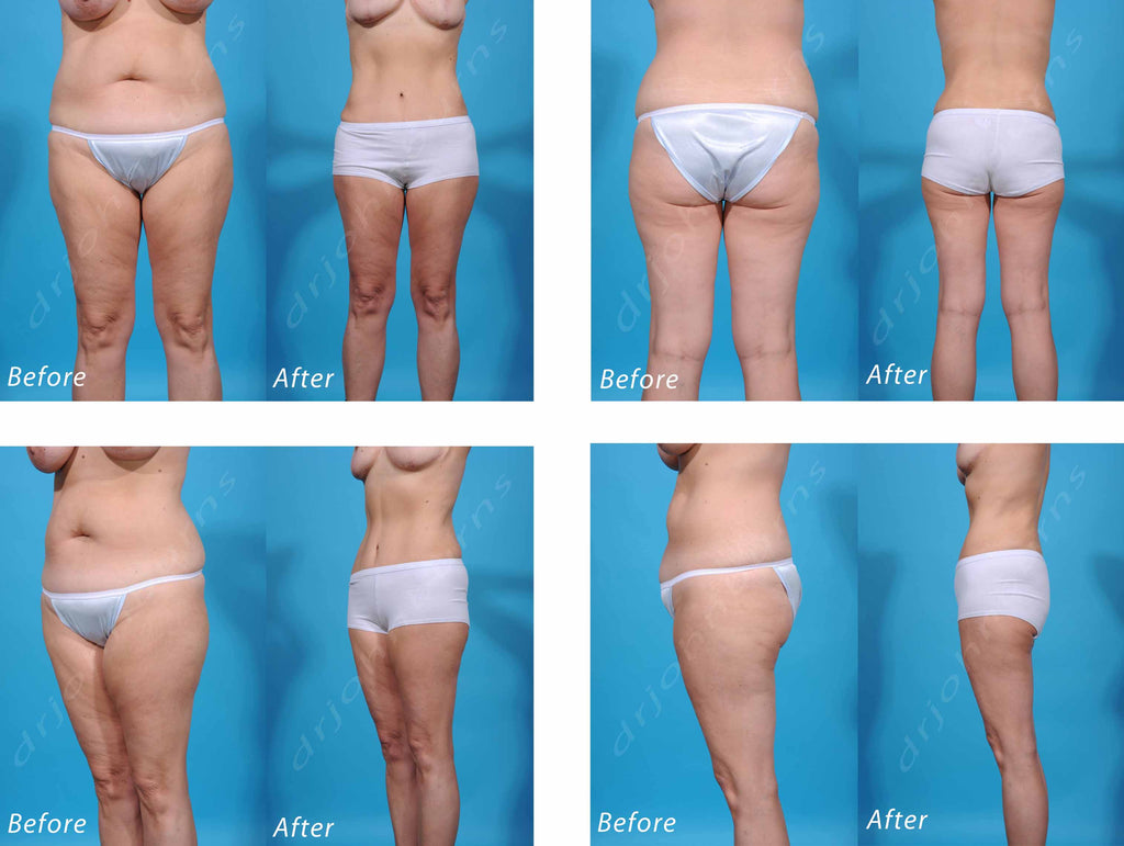 Liposuction Before & After Gallery: Patient 61