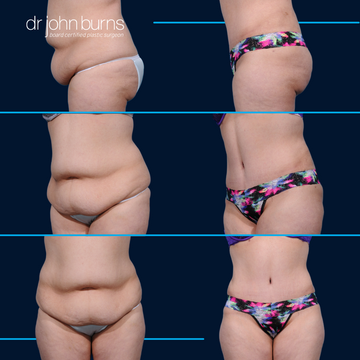 Before and after corset tummy tuck by Dr. John Burns