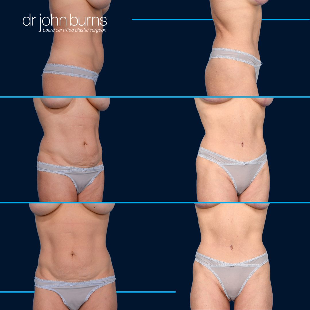 Tummy Tuck Before and After- Dr. John Burns in Dallas, Texas