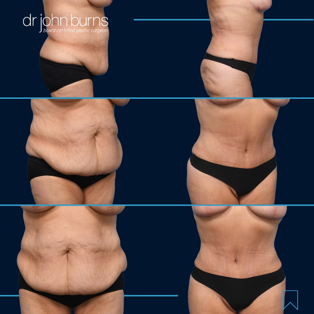 Tummy Tuck with LIpo-Before and After- Dr. John Burns