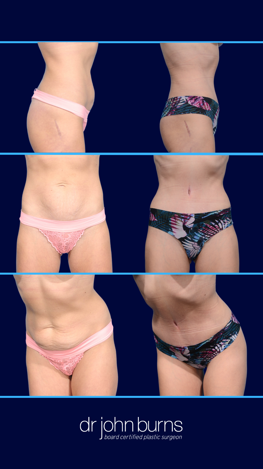 Tummy Tuck + MM +BBL Stories (1).png__PID:1d173f0e-3366-4228-97bc-1394a88842fe