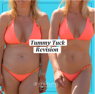 Tummy Tuck Revision.png__PID:dc135e0e-8e03-4668-859e-63065604427a