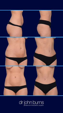 Tummy Tuck before and after in Dallas, Texas- Dr. John Burns.png__PID:4ea75360-e464-472a-8935-8c7e88d6121d