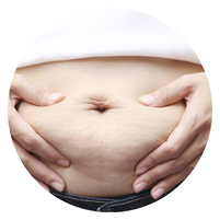 Corset Tummy Tuck- Lipo 360 by Dallas Plastic Surgeon Dr. John Burns – Dr  John Burns