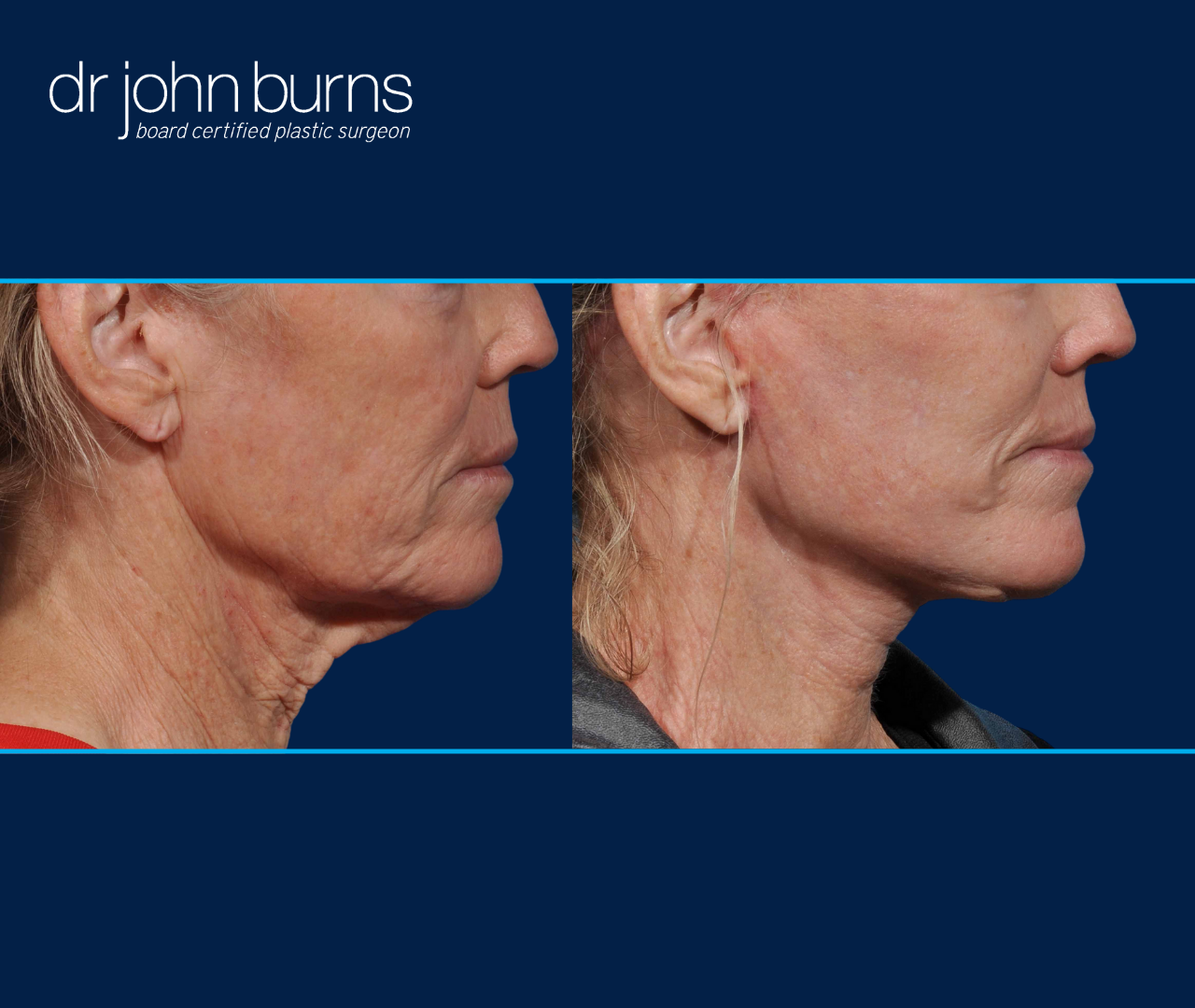 Dallas Buccal Fat Pad Removal by Dr. John Burns – Dr John Burns