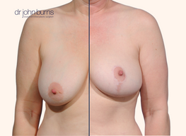 Before and after full breast lift comparison