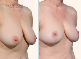 Before and after full breast lift comparison