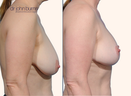 Before and after full breast lift comparison