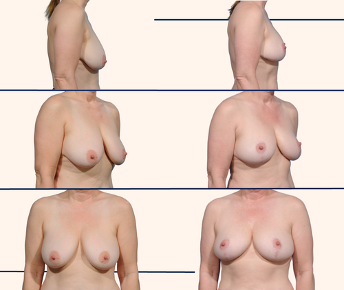 Before and after Breast lift by Dr. John Burns