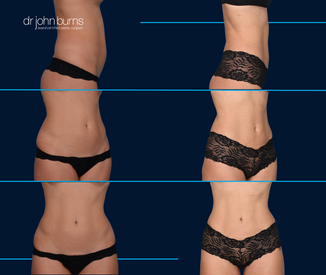 before and after tummy tuck surgery by Dallas Plastic Surgeon, Dr. John Burns