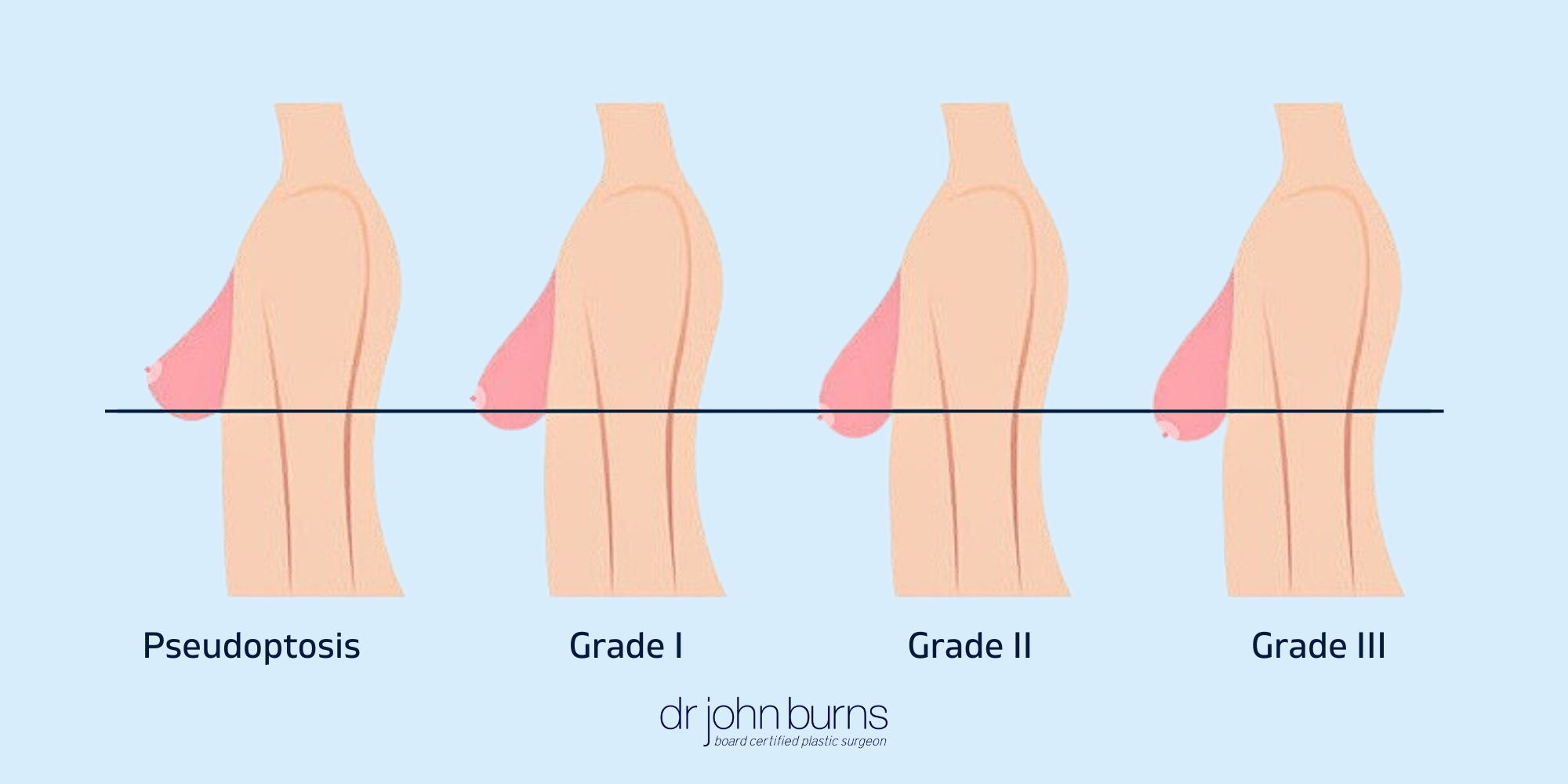 What is breast ptosis? Breast lift with augmentation .png