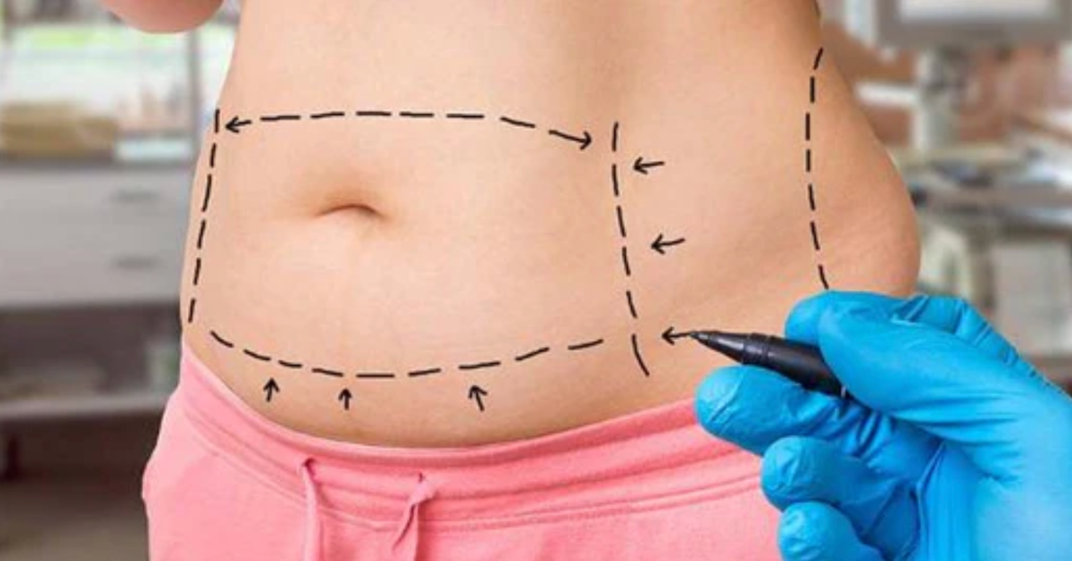 What you should know before tummy tuck surgery?.png__PID:0ebccf45-5c0d-4edf-8561-0e90ca33612d