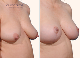 before and after full breast lift comparison