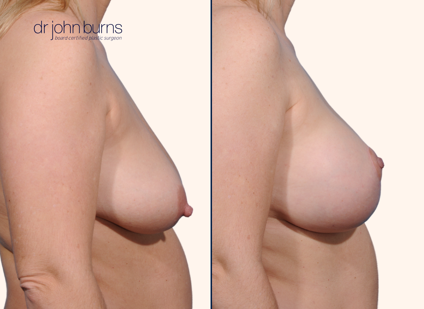 before and after full breast lift comparison