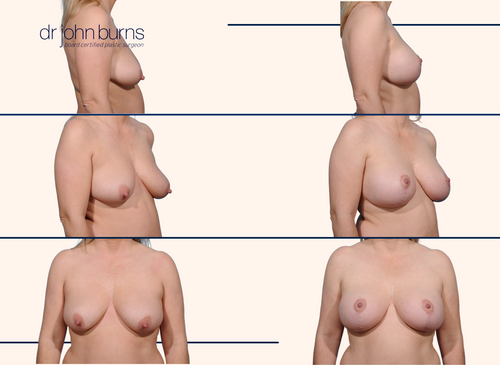 before and after full breast lift 