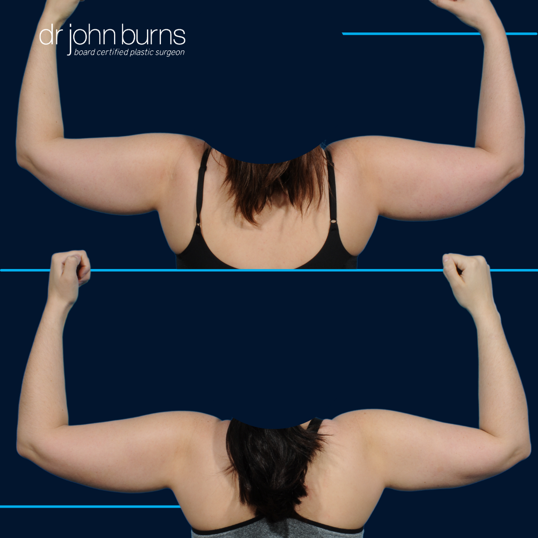 before and after female arm lipo by Dr. John Burns