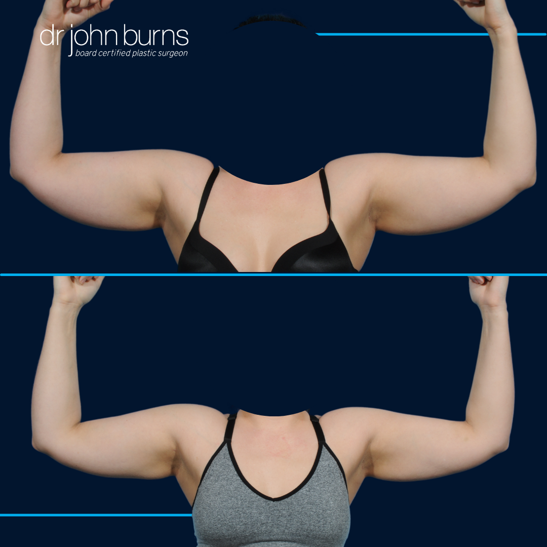 Arm Reduction before and after by Dr. John Burns.png__PID:3df23260-edf5-4945-bcb7-f1a4558ad3ad
