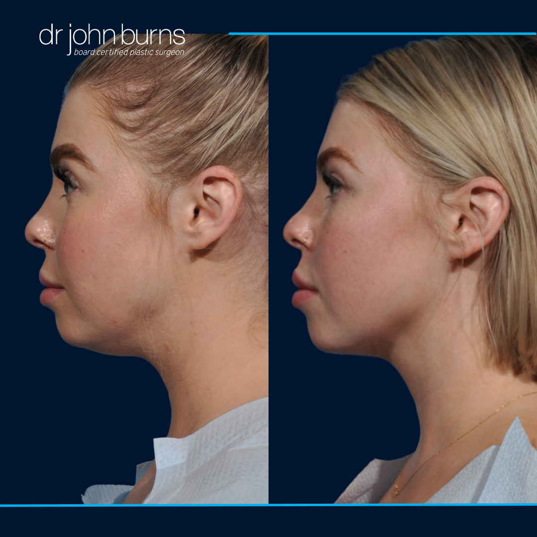 before and after female chin lipo by dallas plastic surgeon, Dr. John Burns