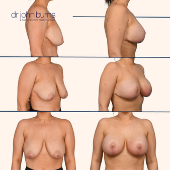 before and after Breast implants with lift by Dr. John Burns.png__PID:1e026029-4607-4f8c-9cc5-7dcbd9ab4afc