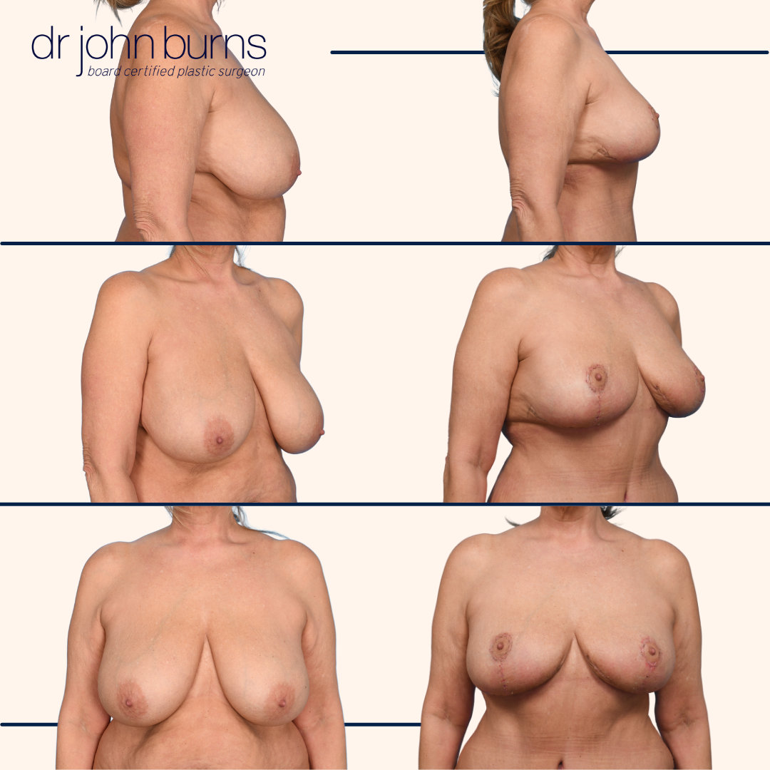 before and after breast full breast lift in dallas.