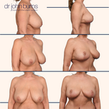 before and after breast full breast lift in dallas.