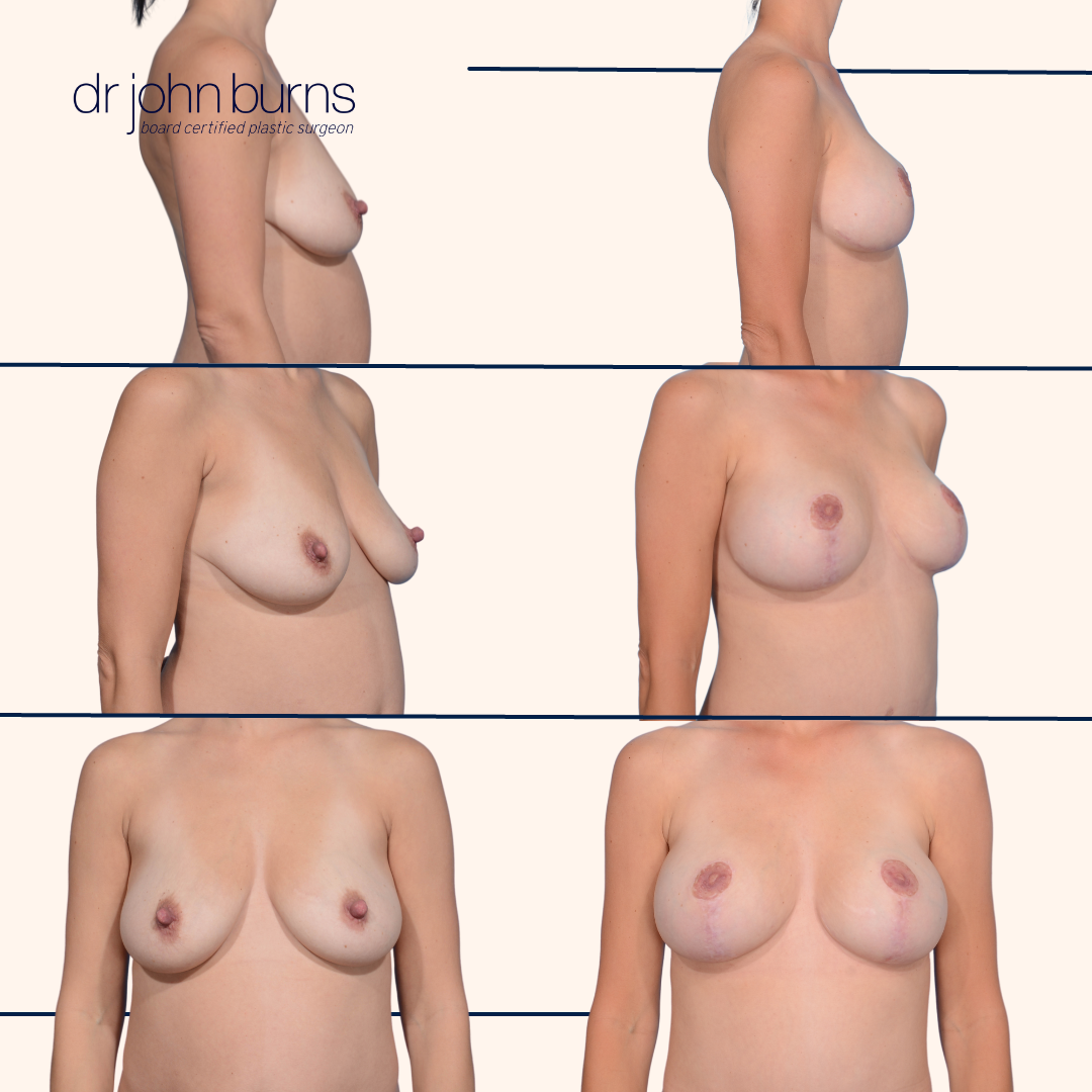before and after breast lift and implants in Dallas, TX by Dr. John Burns.png__PID:130f56e1-b4a1-479e-8168-b40bd7d53dc4