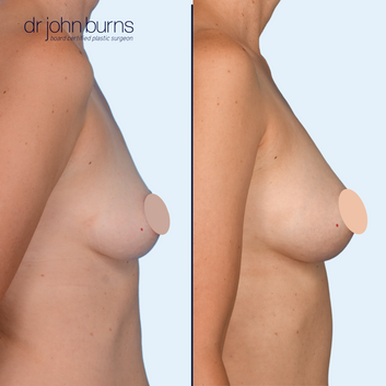 before and after fat transfer in Dallas, Texas- Dr. John Burns.png__PID:52b41a1a-200d-47ec-a73e-0711673765cb