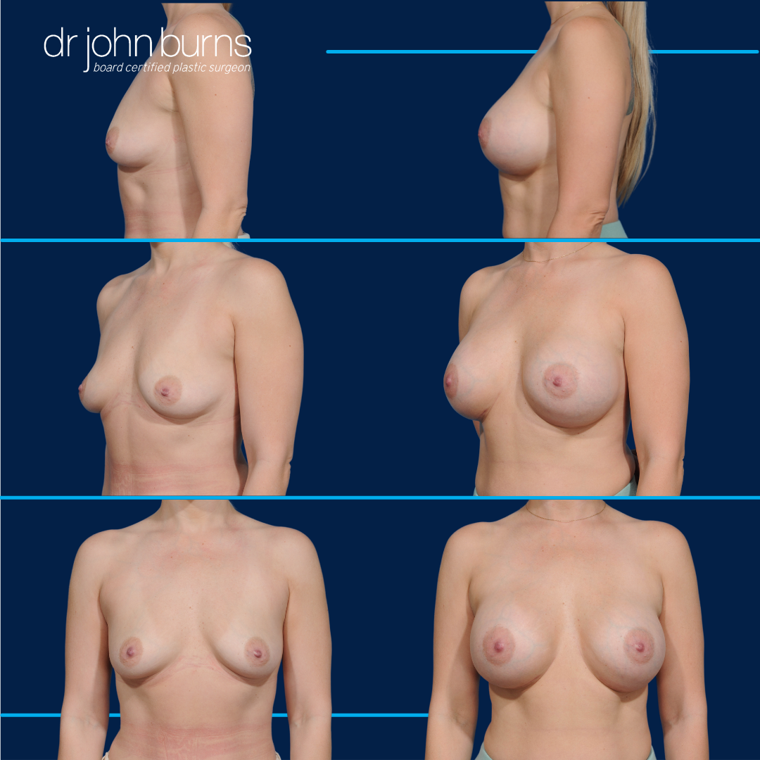 breast augmentation with silicone gel implants.png__PID:8e199a24-7155-4591-8795-f2a6de916019