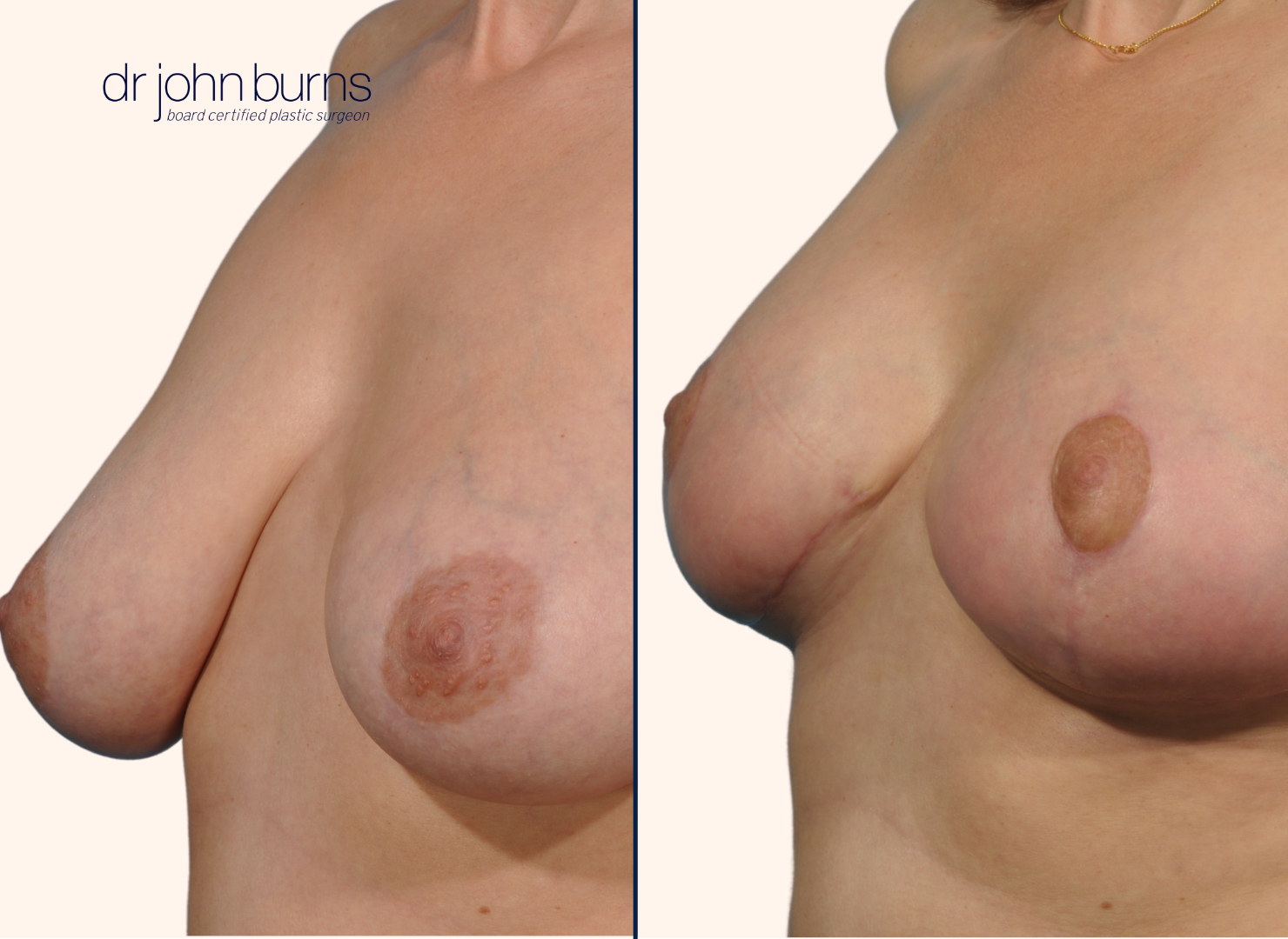 Before and after full breast lift with implants