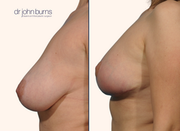 Before and after full breast lift with implants