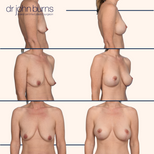 breast lift before and after in dallas.