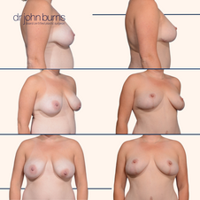 breast lift c fat by Dr. John Burns MD in Dallas, Texas.png__PID:3e47536e-f649-4df2-ab30-a0f871a9f4f2