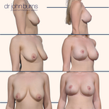 breast lift surgery in dallas.