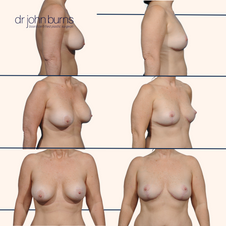 breast lift with fat by Dr. John Burns MD in Dallas, Texas.png__PID:f8182f9f-3be6-4f28-a618-79c9641bbfbe