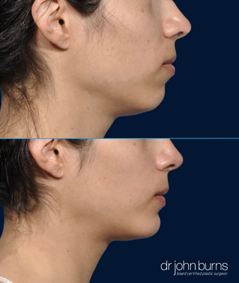 Before and After Chin Implant for a female by Dallas Plastic Surgeon, Dr. John Burns