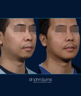 45 Degree View | Before and After Chin Implant for a male by Dallas Plastic Surgeon, Dr. John Burns