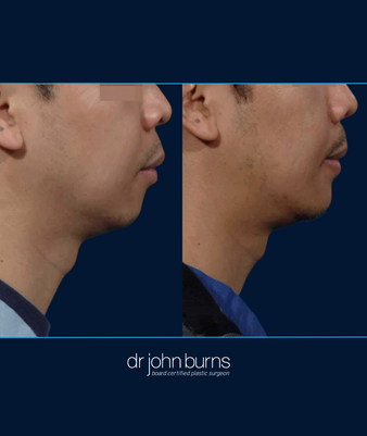 Before and After Chin Implant for a male by Dallas Plastic Surgeon, Dr. John Burns