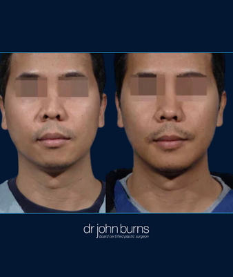 Front Facing View | Before and After Chin Implant for Male by Dallas Plastic Surgeon, Dr. John Burns