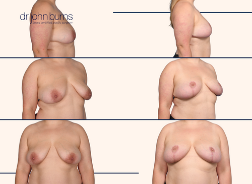 Breast lift before and after by Dr. John Burns