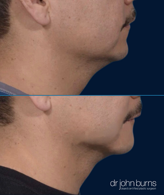 Profile Chin Implant Results for a Male in Dallas by Dr. John Burns