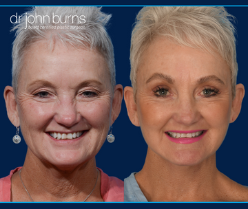 Double Eyelid Surgery before and after with facelift and neck lift by Dr. John Burns in Dallas, Texas