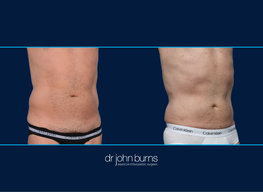 Athletic Male | Before and After Male Liposuction, Dallas Texas