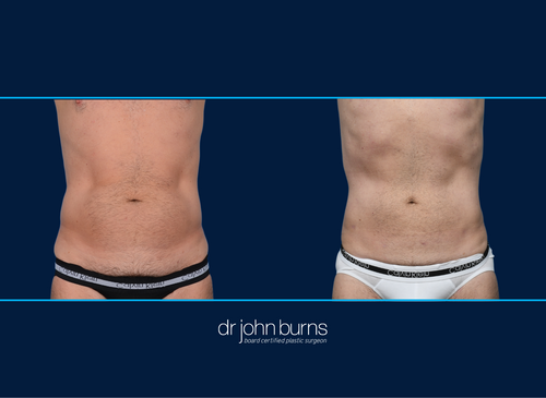 Athletic Male | Before and After Male Liposuction, Dallas Texas