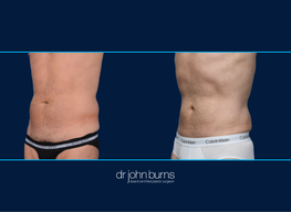 Athletic Male | Before and After Male Liposuction, Dallas Texas