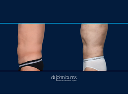 Left Profile View | Athletic Male | Before and After Male Liposuction, Dallas Texas