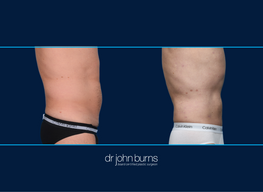 Right Profile View | Athletic Male | Before and After Male Liposuction, Dallas Texas