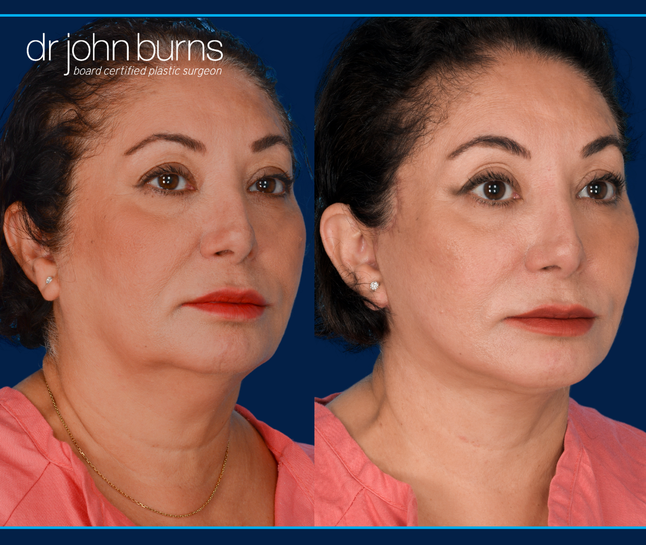 Before and after facelift by Dallas Facelift Specialist, Dr. John Burns