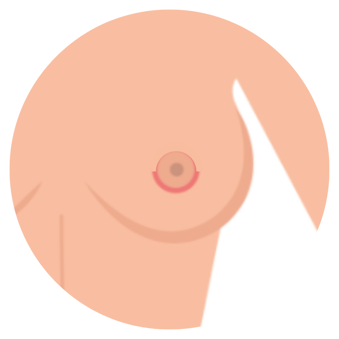 crescent breast lift by Dr. John Burns.png__PID:22aa3ec4-fd05-4495-bae0-3031487f0af3