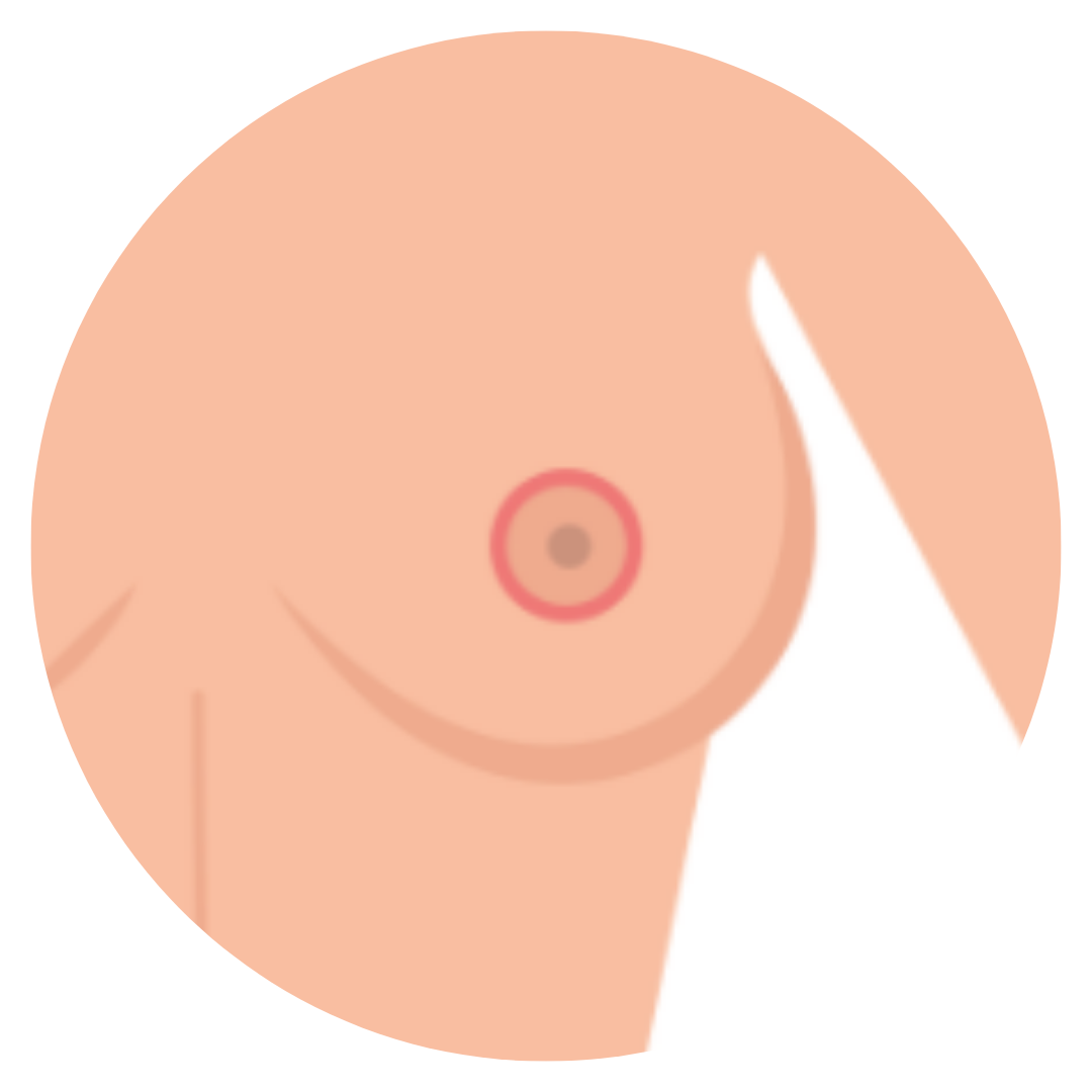 donut (benelli) breast lift by Dr. John Burns.png__PID:aa3ec4fd-0564-457a-a030-31487f0af374