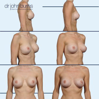 before and after explant surgery by Dr. Burns